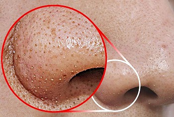 THE EXTRACTION FACIAL!