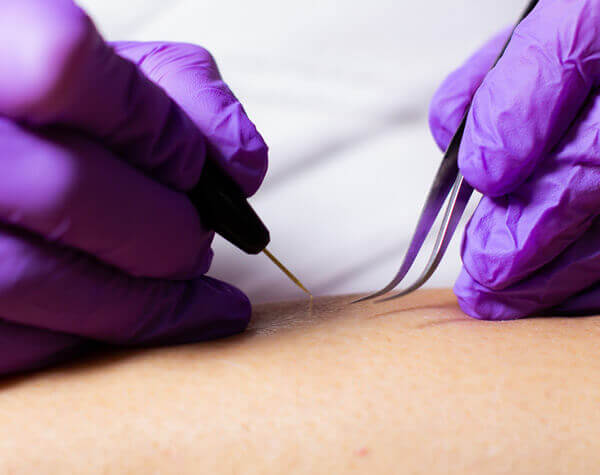 Advanced Skin Lesion Removal