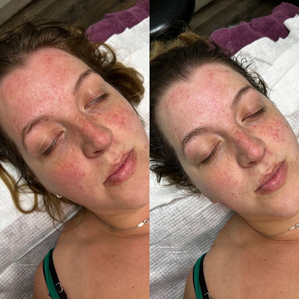 Omega Green Treatment