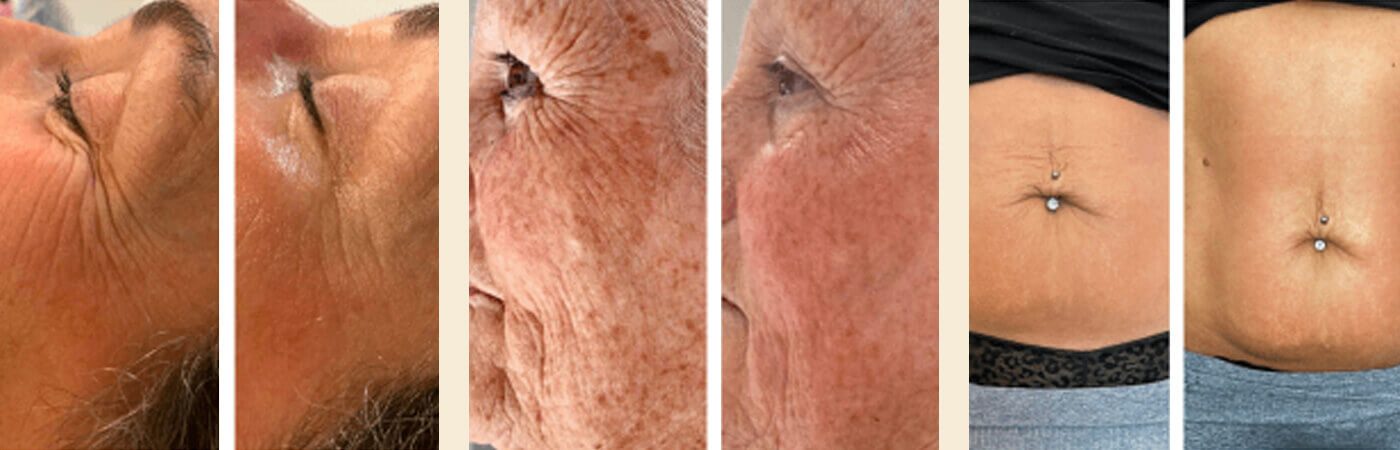 Radiofrequency skin tightening nottingham